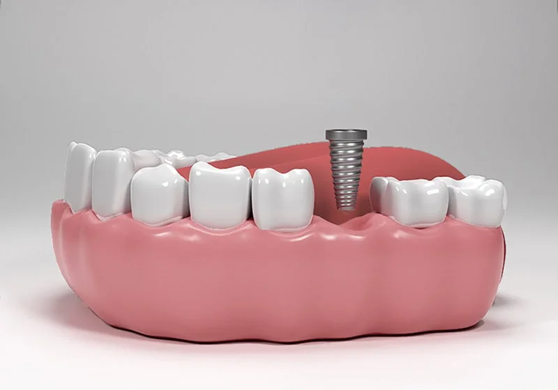 Model 3D: implantul dentar inserat în os, între dinții vecini