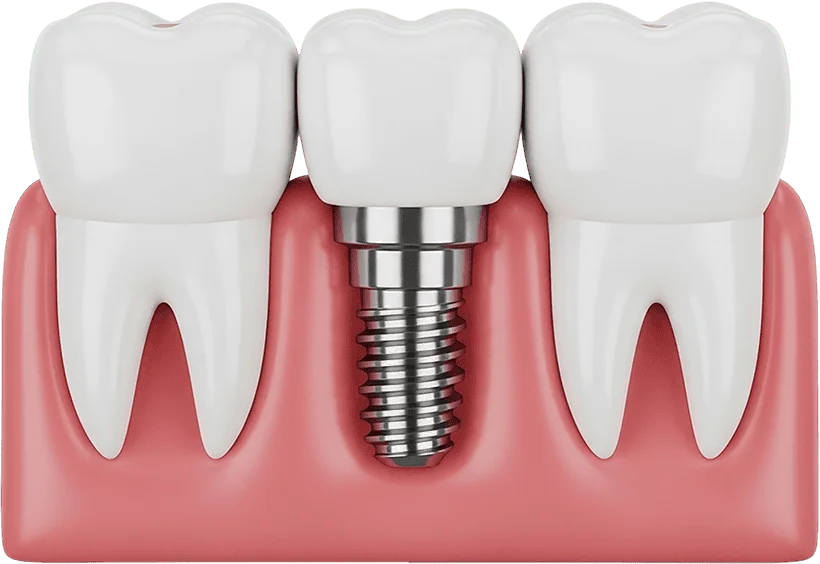 Model 3D: implant dentar cu coroană, între doi dinți naturali